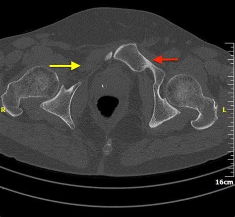 Cureus | Pubic Bone Aplasia as an Incidental Finding in the Adult Population: Case Report and ...