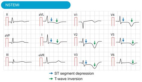 Classification Of Acute Coronary Syndromes Acs Acute Myocardial 12600 | The Best Porn Website