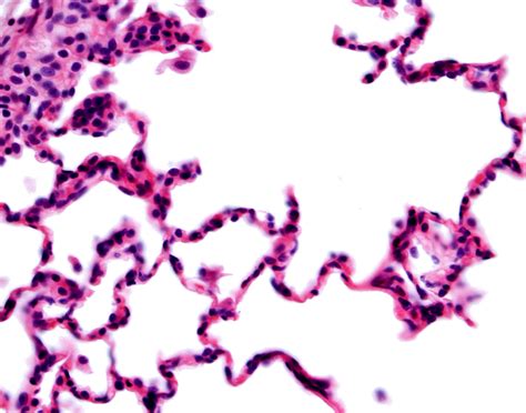 pleural-needle-biopsy-708x556-2x