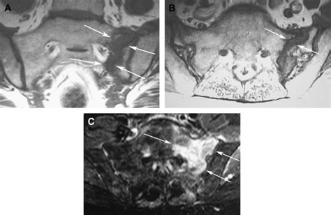 Sacral Fractures and Sacroplasty | Radiology Key