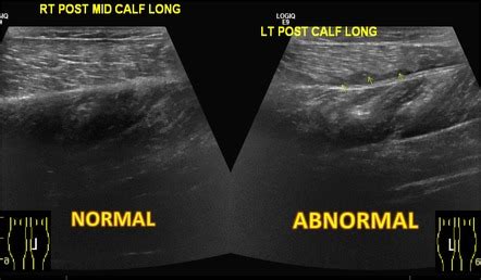 Tennis leg | Radiology Reference Article | Radiopaedia.org