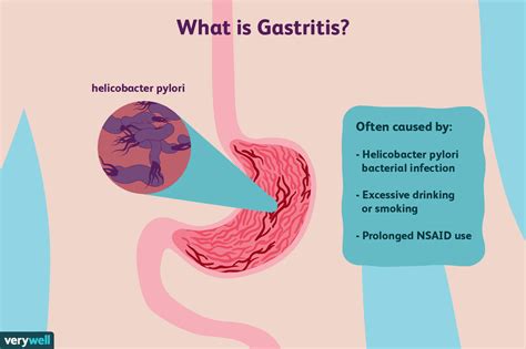Gastritis Symptoms, Causes, and Treatment