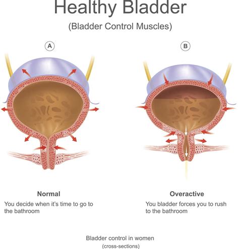 What Causes Bladder Leakage? - NoiMag