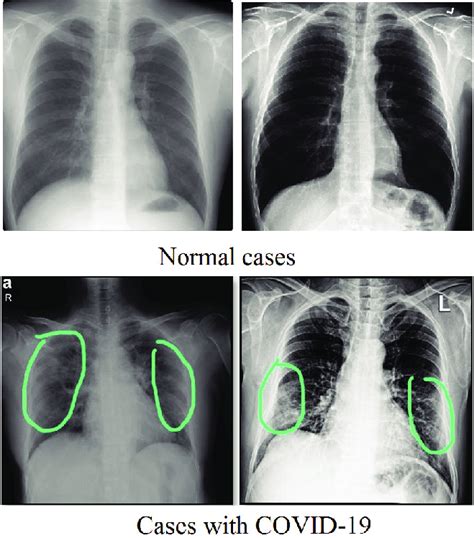 Samples of normal scans chest X-rays versus ones diagnosed with COVID ...