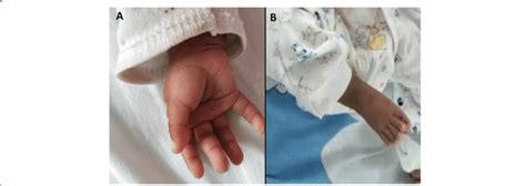 Malformation of hands and feet. A single transverse palmar crease (a);... | Download Scientific ...