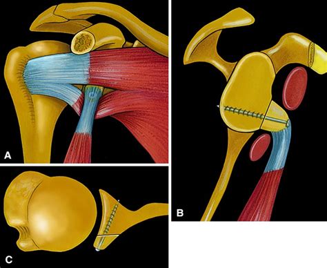 Latarjet and Failed Shoulder Instability Repair | Shoulder Injuries ...