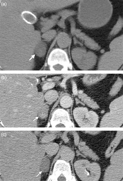 Lipid-poor adenoma. (A) Unenhanced CT of the abdomen showing a right... | Download Scientific ...