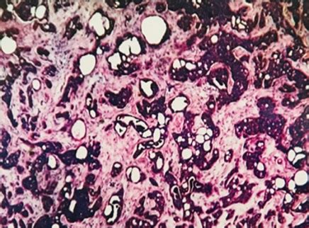 Histopathological spectrum of salivary gland neoplasms - IP J Diagn Pathol Oncol