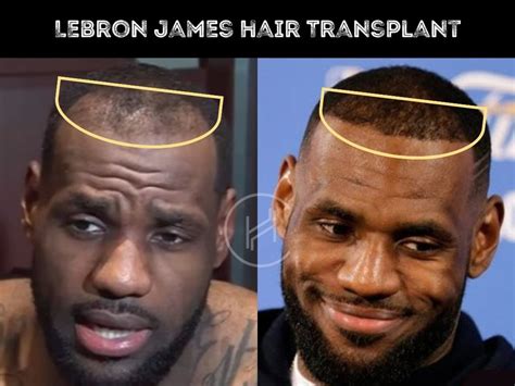 LeBron James Hair Transplant - Hair Loss & Technical Analysis