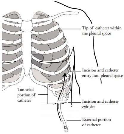 About Your PleurX Drainage Catheter - Interventional Pulmonology | Memorial Sloan Kettering ...