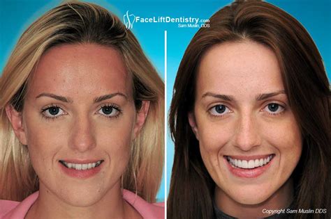 Adult Crossbite Correction Without Braces