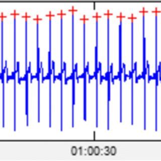 R wave detection of ECG signals | Download Scientific Diagram