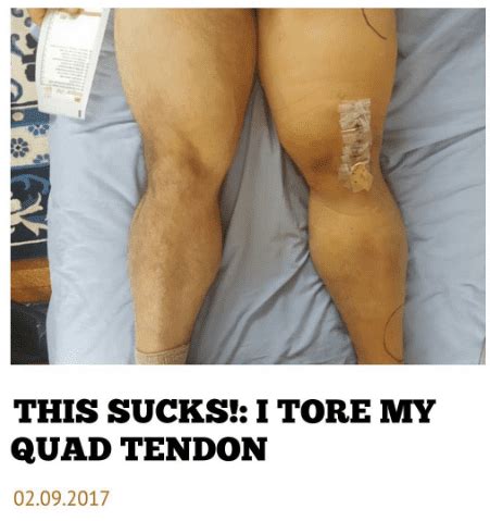 Another IFBB Pro Bodybuilder Suffers A Quad Tendon Tear – Quadriceps ...