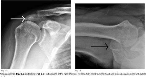 Figure 4 from Os Acromiale Rupture Associated with a Massive Rotator ...