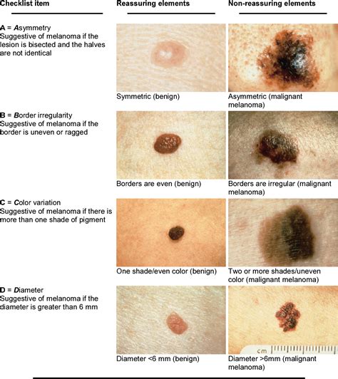 Table I from Adoptive Cell Transfer and Lymphodepleting Chemotherapy for the Treatment of ...