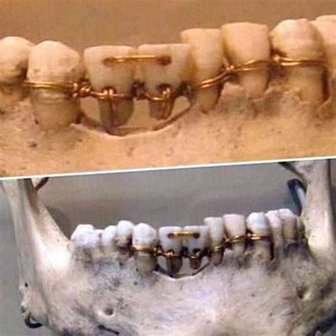 Dental work found on a 4,000- year old mummy in ancient Egypt - 9GAG