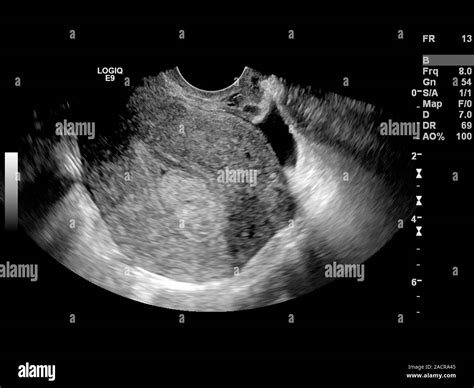 Endometrial polyp. Ultrasound scan of the uterus (womb) of a 42 year old female patient with a ...