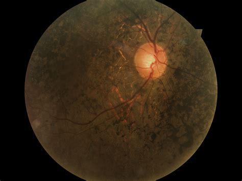 6 questions with answers in RETINITIS PIGMENTOSA | Science topic