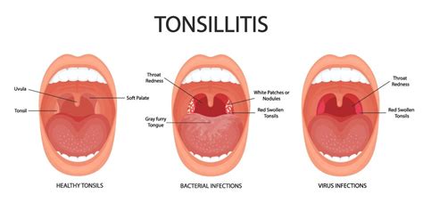 Tonsillitis - Causes, Symptoms and Treatment - Nobel Medical Group