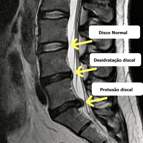 Doença discal degenerativa