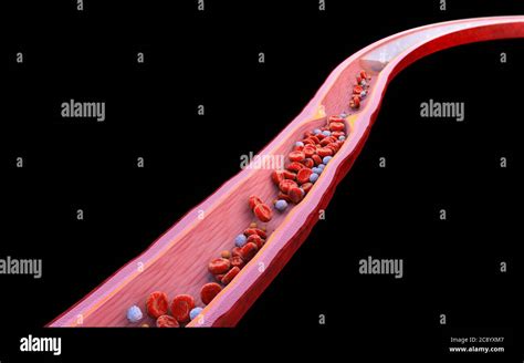 cross-section vein, artery, Atherosclerosis illustration. High ...