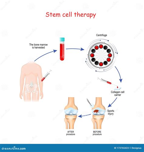 Stem Cell Therapy. before and after of Sports Injury Stock Vector - Illustration of care ...