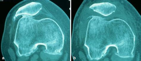 Partial lateral facetectomy plus Insall’s procedure for the treatment of isolated patellofemoral ...