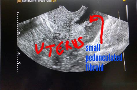 Ultrasound imaging: Small pedunculated fibroid