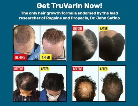 TruVarin contains all-natural ingredients, there are no harmful side effects that come f… | Hair ...