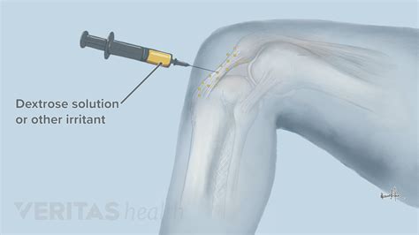 What is the most effective injection for arthritis? - 27F Chilean Way