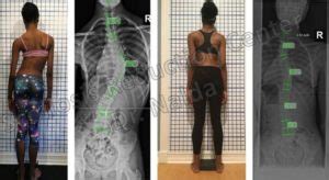 before after scoliosis treatment