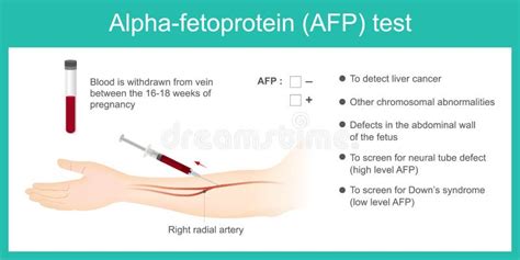 Alpha-fetoprotein AFP Test. Stock Illustration - Illustration of ...