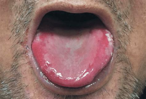 Ulcerated lesions of the tongue. | Download Scientific Diagram