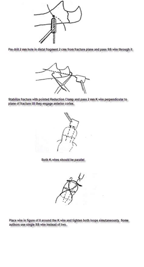 Tension Band Wiring Procedure | Bone and Spine