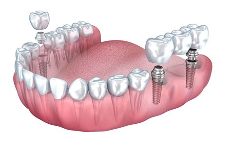 Dental Bridge vs Implant Cost | Dental Associates of Lodi