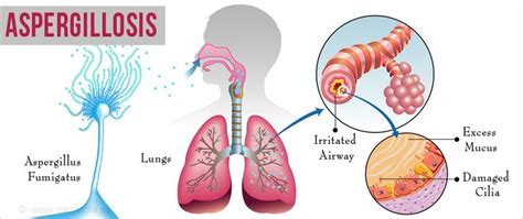 Pin on Aspergillus and aspergillosis