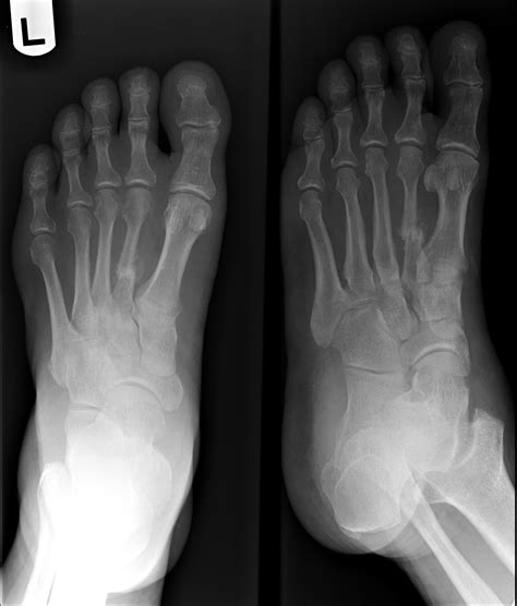 emDOCs.net – Emergency Medicine EducationCORE EM: Lisfranc Injuries ...