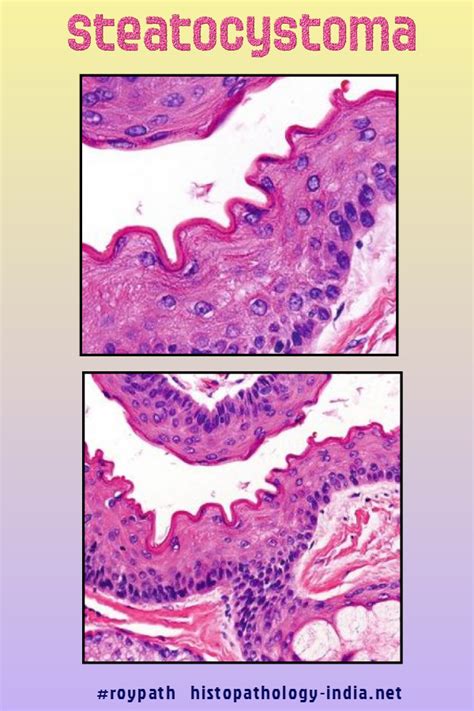 Pin on Dermatopathology and Soft Tissue Pathology