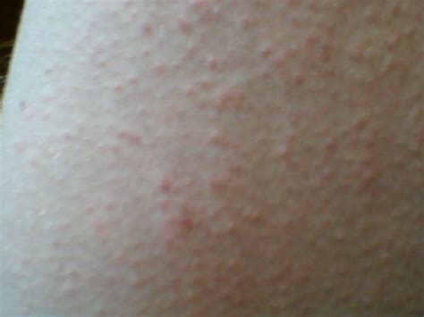 pimply rash on legs - pictures, photos