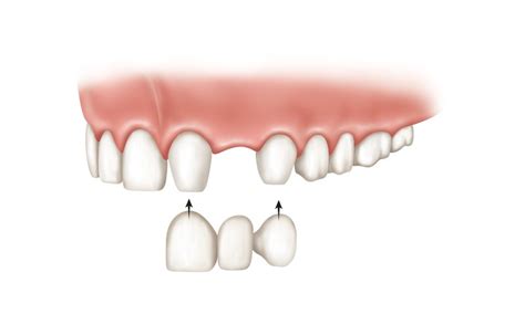 Front Teeth Dental Bridges - Lane & Associates