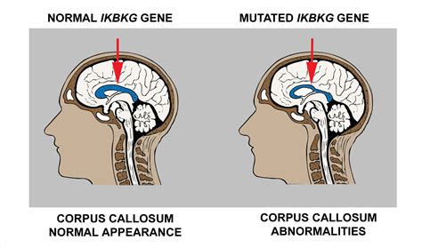 Diagnostics | Free Full-Text | The Impact of the IKBKG Gene on the ...