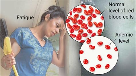 New Focus on Reducing Anemia in Adolescent Girls