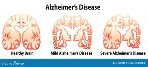 Alzheimer's Disease Stock Images - Image: 34803164