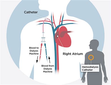 Kidney Dialysis Treatment - UChicago Medicine