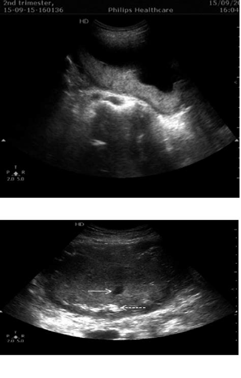 Third trimester placenta. | Download Scientific Diagram