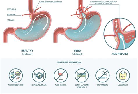 Causes of Acid Reflux & Dietary Modification