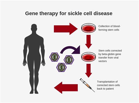 sickle cell disease cure Sickle cell disease - Diseases Club Center 2