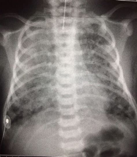 Meconium aspiration syndrome. | Pediatric Radiology