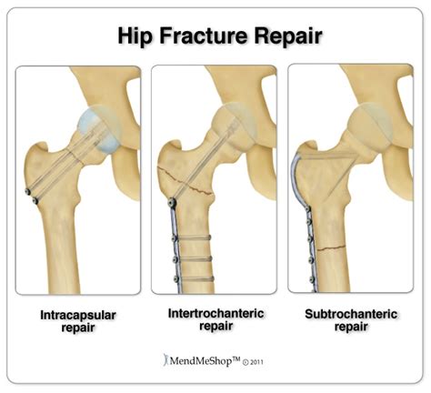 Hip Fracture Information