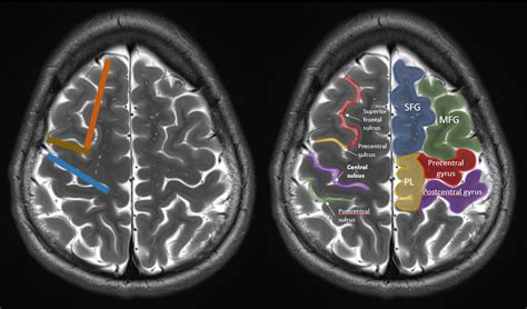 How to find the central sulcus on imaging? – The Neuroradiologist